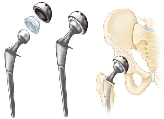 Para cirurgia de quadril, morador do interior faz vaquinha virtual; cirurgia custa R$ 80 mil