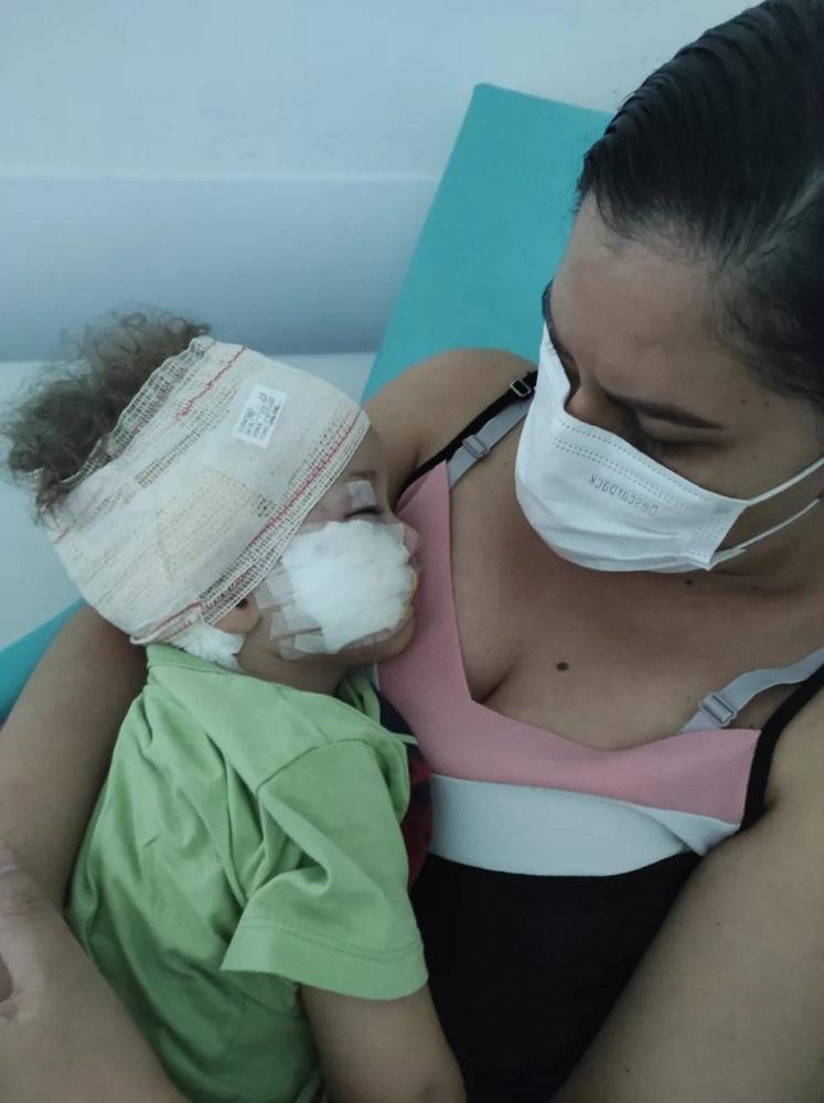 Cão morde bebê que perde parte da face e da orelha; ataque foi na casa da babá