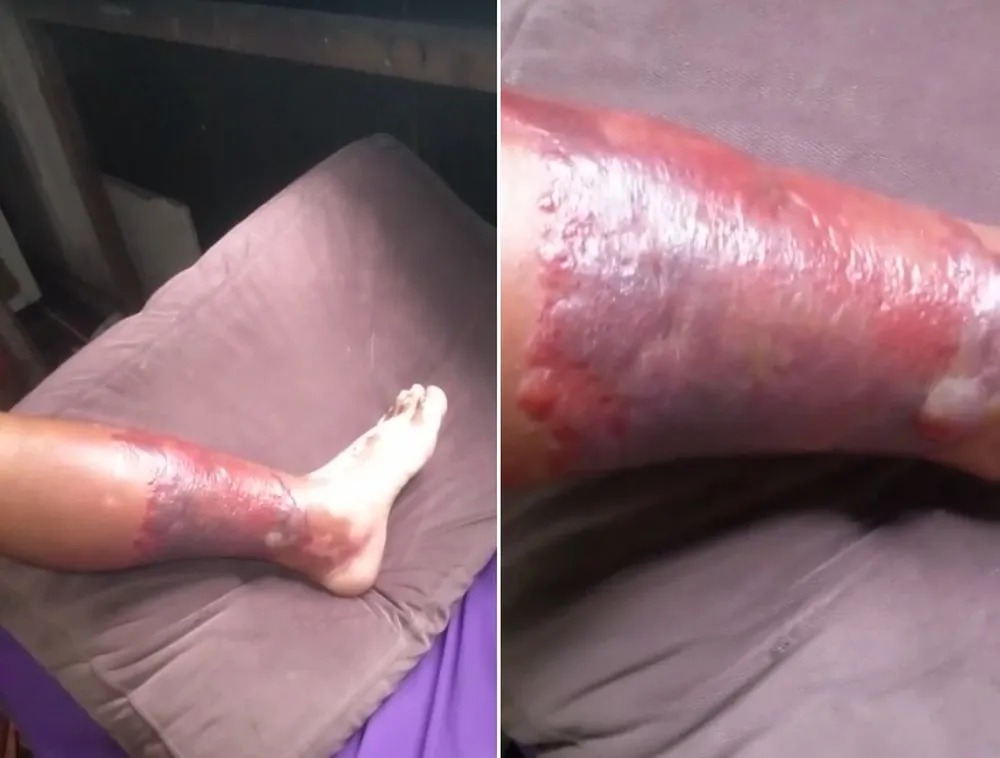 Trabalhador é infectado e sofre com erisipela nas duas pernas; água podre da chuva seria causa
