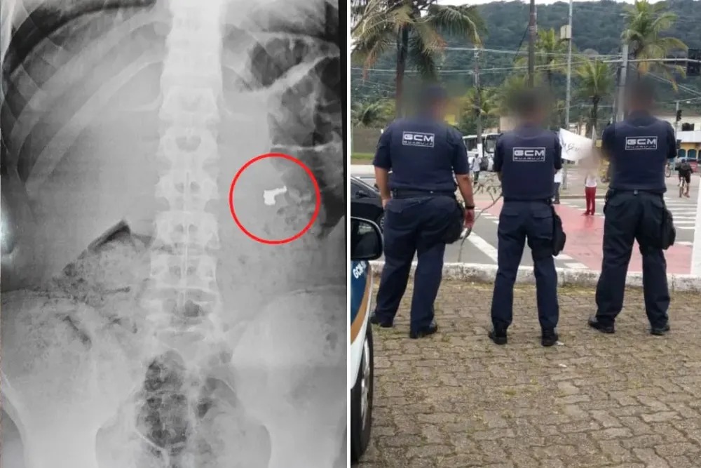 Adolescente engole correntinha de ouro roubada para evitar detenção;foi parar na Upa