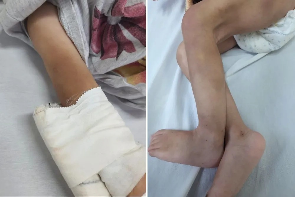 Bebezinha de um ano dá entrada em hospital com vários ferimentos;não é a primeira vez