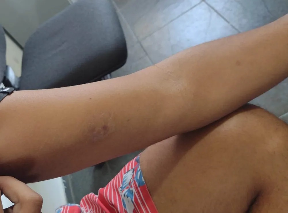 Vítima se defende de roubo e ataca ladrão com mordidas no braço
