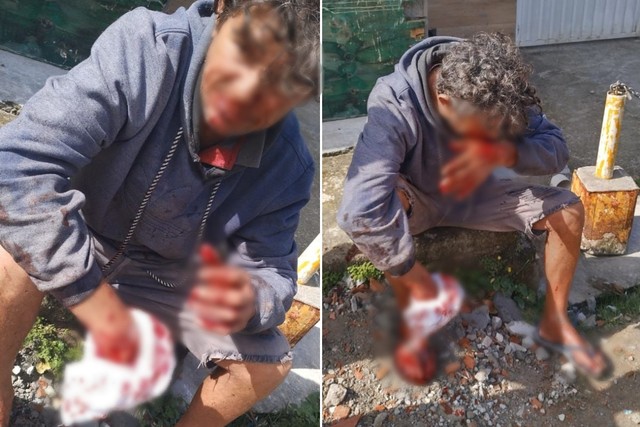 Cachorro ataca homem com mordidas no pescoço e braço; escapou da morte