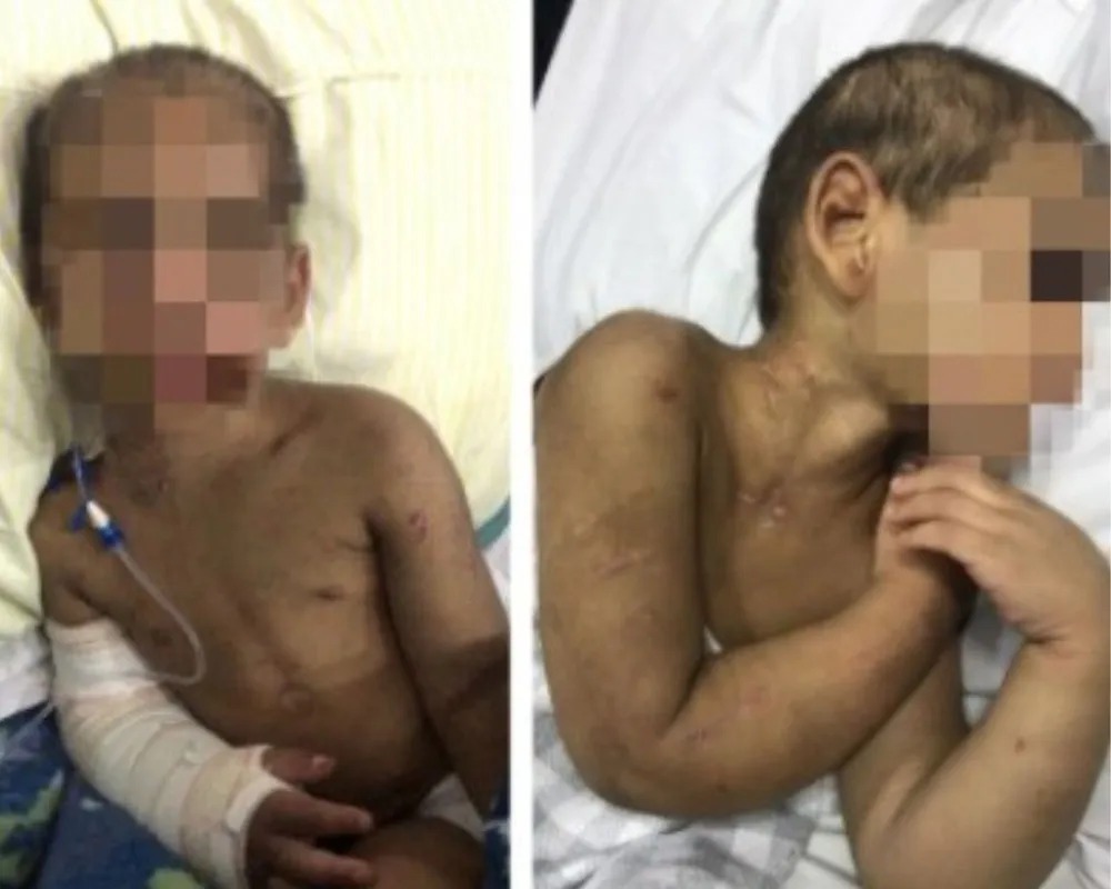 Criança é espancada por mãe e padrasto; oito costelas e braço fraturados